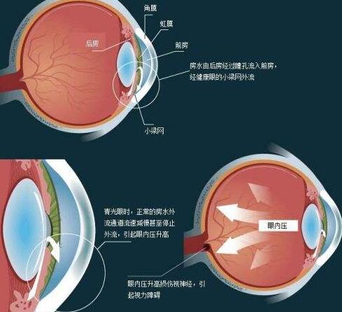 青光眼产生原因.jpg 青光眼产生原因.jpg