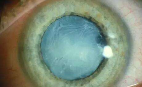 白内障医治.jpg 白内障医治.jpg