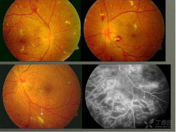 糖尿病视网膜病