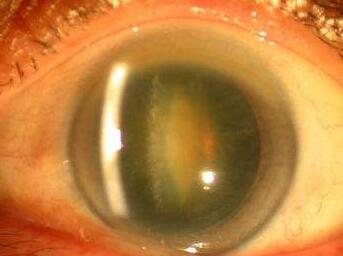 白内障手术方式.jpg 白内障手术方式.jpg