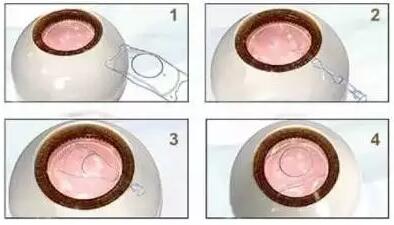 ICL晶体植入术13.jpg ICL晶体植入术13.jpg