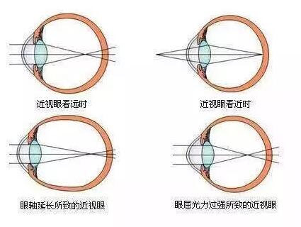 “小孩视力以前挺好的,没想到一个寒假下来就近视了。”昨天的金沙9001以诚为本小儿眼科门诊里,很多家长都反应说,“孩子期末成绩不错,所以假期里对他的管束放松了,一有空就拿起手机玩。直到前几天,他嚷着看东西变模糊了,才带孩子来医院检查,检查结果是左右眼出现不同程度的近视,医生建议配戴眼镜。.jpg “小孩视力以前挺好的,没想到一个寒假下来就近视了。”昨天的金沙9001以诚为本小儿眼科门诊里,很多家长都反应说,“孩子期末成绩不错,所以假期里对他的管束放松了,一有空就拿起手机玩。直到前几天,他嚷着看东西变模糊了,才带孩子来医院检查,检查结果是左右眼出现不同程度的近视,医生建议配戴眼镜。.jpg