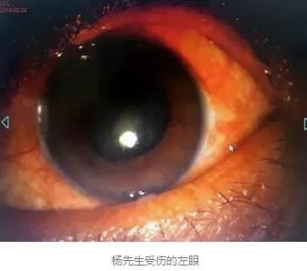 白内障和青光眼都是致盲性眼病，其中青光眼的病程不逆转。杨先生拖延伤情导致同时并发白内障、青光眼的情况，十分令人惋惜。”出名眼科专家、成都金沙9001以诚为本陈晓明教授表示2.jpg