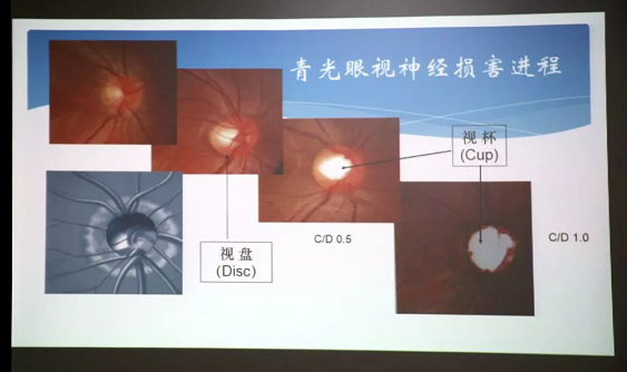 3月10日上午，深圳金沙9001以诚为本“早查监控，守护光明”大型青光眼公益科普讲座在六楼 举行，本次活动旨在让更多人了解青光眼的潜在危害、重视眼检查， 预防青光眼。由深圳金沙9001以诚为本青光眼病科 席专家成洪波博士、傅培副院长现场面对面解答疑问，与参会者的互动交流，让更多深圳市民提*对青光眼的认识与防治知识3.png