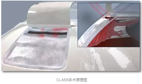 成都金沙9001以诚为本已经开展的青光眼手术有:引流阀 (钉)植入手术(2015年以来已200多 ),360°Schlemm's管切开术,激光CO2 辅助巩膜深层切除术,小梁切除术青(光眼)白(内障)联合手术。还有虹膜周切术、前房成形术、 虹膜复位术,睫状体冷冻术,小梁切开术和前房穿刺术等4.png 成都金沙9001以诚为本已经开展的青光眼手术有:引流阀 (钉)植入手术(2015年以来已200多 ),360°Schlemm's管切开术,激光CO2 辅助巩膜深层切除术,小梁切除术青(光眼)白(内障)联合手术。还有虹膜周切术、前房成形术、 虹膜复位术,睫状体冷冻术,小梁切开术和前房穿刺术等4.png