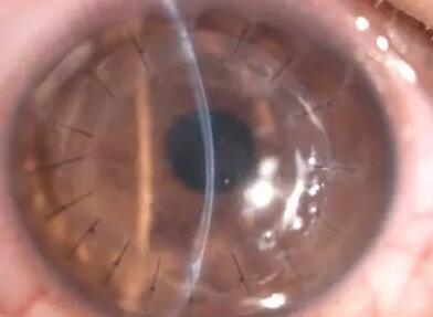 厦门眼科中心商旭敏博士介绍:角膜移植手术在所有器官移植中属于排斥反应 少的手术,随着手术器械的改进,以及手术技术的提*,目前角膜移植的 率越来越高,如排斥率较低的圆锥角膜, 率就可达到90%以上1.jpg 厦门眼科中心商旭敏博士介绍:角膜移植手术在所有器官移植中属于排斥反应 少的手术,随着手术器械的改进,以及手术技术的提*,目前角膜移植的 率越来越高,如排斥率较低的圆锥角膜, 率就可达到90%以上1.jpg