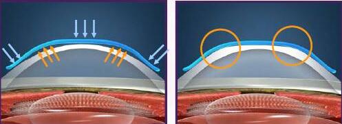 角膜塑形镜是如何 孩子近视的?.jpg 角膜塑形镜是如何 孩子近视的?.jpg