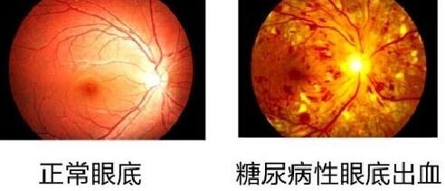 糖尿病视网膜病变有哪几种医治方式?2.jpg 糖尿病视网膜病变有哪几种医治方式?2.jpg