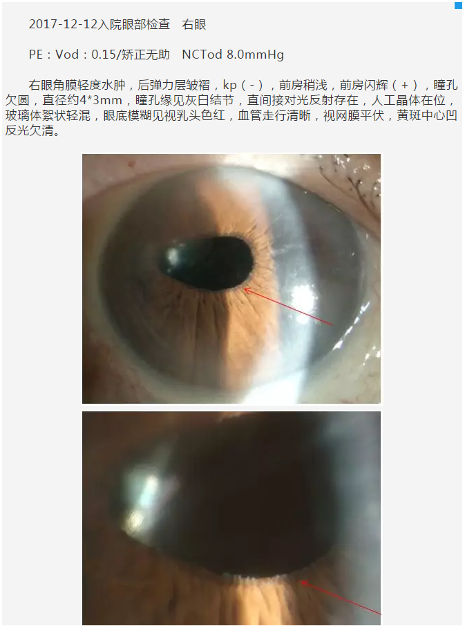 厦门眼科中心复杂性白内障手术案 研讨会持续进行4.png