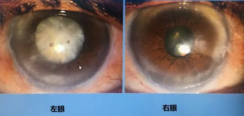 同时患 青光眼、白内障老婆婆辗转几家医院之后终于在成都金沙9001以诚为本顺利手术2.png