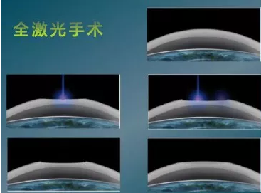 全国高考成绩分数线陆续出来了安徽理工大学附属眼科医院近视手术医生温馨提醒近视考生要注意这些1.png 全国高考成绩分数线陆续出来了安徽理工大学附属眼科医院近视手术医生温馨提醒近视考生要注意这些1.png