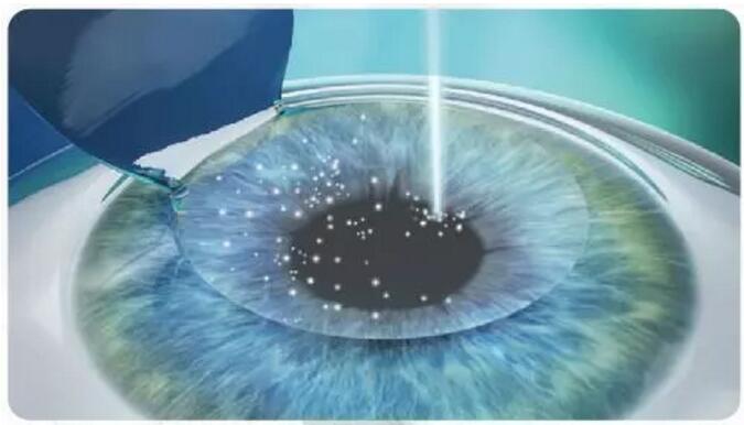 2020年征兵视力要求已出炉,近视青年你们准备好了吗?4.jpg 2020年征兵视力要求已出炉,近视青年你们准备好了吗?4.jpg