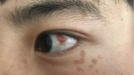 四川丹巴15岁男孩患结膜血管瘤,在成都金沙9001以诚为本顺利手术1.jpg 四川丹巴15岁男孩患结膜血管瘤,在成都金沙9001以诚为本顺利手术1.jpg