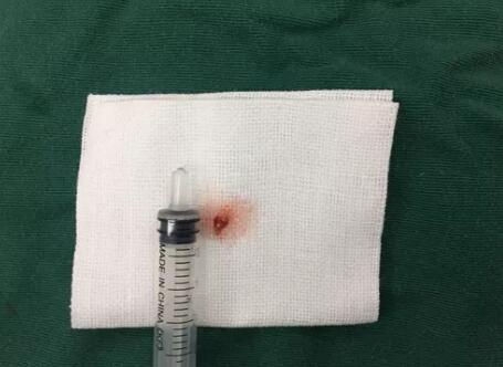 四川丹巴15岁男孩患结膜血管瘤,在成都金沙9001以诚为本顺利手术3.jpg 四川丹巴15岁男孩患结膜血管瘤,在成都金沙9001以诚为本顺利手术3.jpg