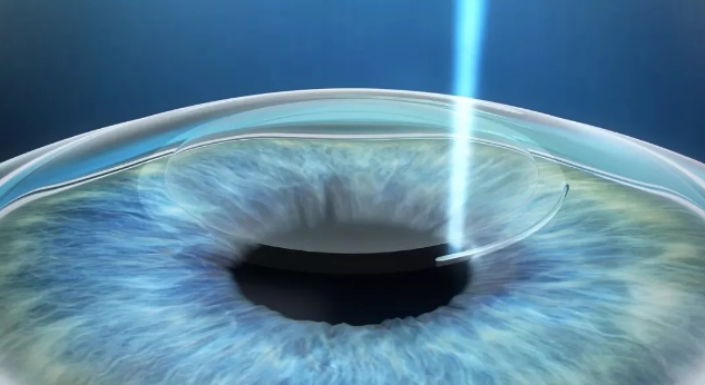 戴口罩近视眼镜总起雾怎么办?试试这几种办法:近视手术摘镜2.png 戴口罩近视眼镜总起雾怎么办?试试这几种办法:近视手术摘镜2.png