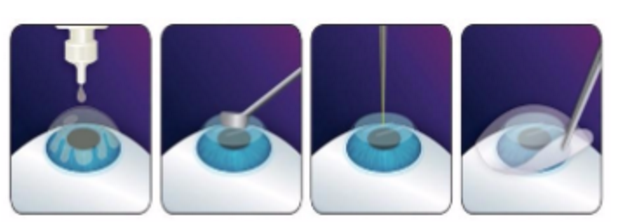 近视无法根治?但你可以这样做?金沙9001以诚为本“有爱就有希望”近视手术火热进行中1.png 近视无法根治?但你可以这样做?金沙9001以诚为本“有爱就有希望”近视手术火热进行中1.png