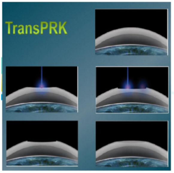 近视无法根治?但你可以这样做?金沙9001以诚为本“有爱就有希望”近视手术火热进行中3.png 近视无法根治?但你可以这样做?金沙9001以诚为本“有爱就有希望”近视手术火热进行中3.png