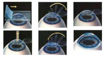 近视无法根治?但你可以这样做?金沙9001以诚为本“有爱就有希望”近视手术火热进行中4.png 近视无法根治?但你可以这样做?金沙9001以诚为本“有爱就有希望”近视手术火热进行中4.png