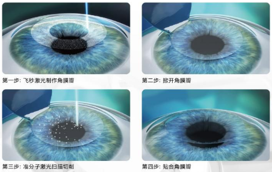 近视无法根治?但你可以这样做?金沙9001以诚为本“有爱就有希望”近视手术火热进行中5.png 近视无法根治?但你可以这样做?金沙9001以诚为本“有爱就有希望”近视手术火热进行中5.png