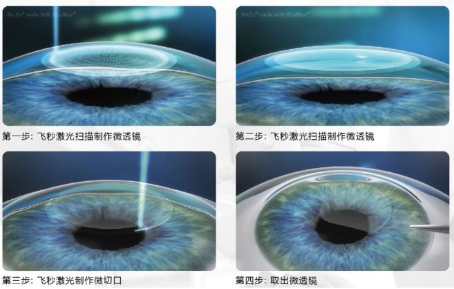 近视无法根治?但你可以这样做?金沙9001以诚为本“有爱就有希望”近视手术火热进行中6.png 近视无法根治?但你可以这样做?金沙9001以诚为本“有爱就有希望”近视手术火热进行中6.png