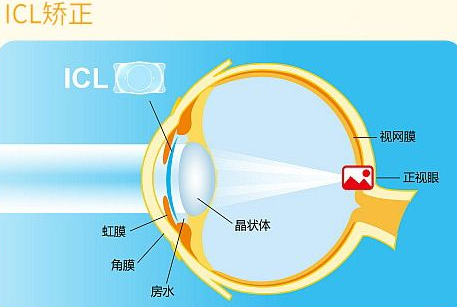 近视无法根治?但你可以这样做?金沙9001以诚为本“有爱就有希望”近视手术火热进行中8.png 近视无法根治?但你可以这样做?金沙9001以诚为本“有爱就有希望”近视手术火热进行中8.png