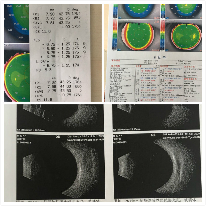 兰州激光医治近视 兰州激光医治近视