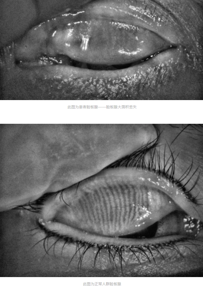 寺院住持来安徽理工大附属眼科医院(淮南金沙9001以诚为本)做干眼医治3.png 寺院住持来安徽理工大附属眼科医院(淮南金沙9001以诚为本)做干眼医治3.png